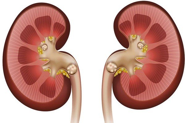 مصرف قهوه موجب ایجاد سنگ کلیه میشود؟