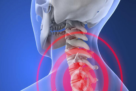 روش های درمان آرتروز گردن/ استفاده از گردن بندهای طبی برای مدت طولانی ممنوع