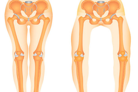 درمان نکردن "پای پرانتزی" موجب آسیب به مفصل زانو می شود