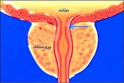 پروستات چه زمانی به جراحی نیاز دارد؟/ داروها بدون نظر پزشک قطع نشوند