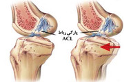 علائم و پیشگیری از پارگی رباط "صلیبی قدامی"/ احتمال مصدومیت  زنان ۵ برابر مردان است