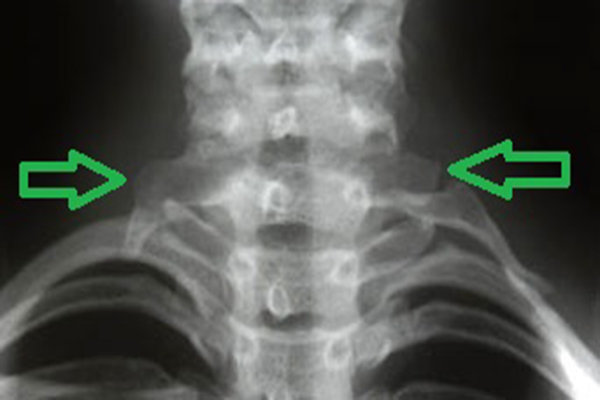 آشنایی با عارضه "دنده گردنی"/  علائم  بیماری معمولا در ابتدای بلوغ ظاهر می شود