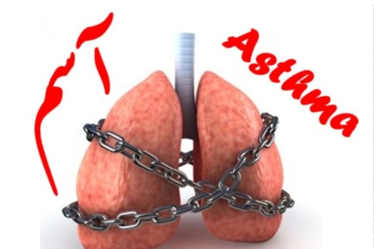 آسم؛ شایع‌ترین بیماری مزمن در جهان