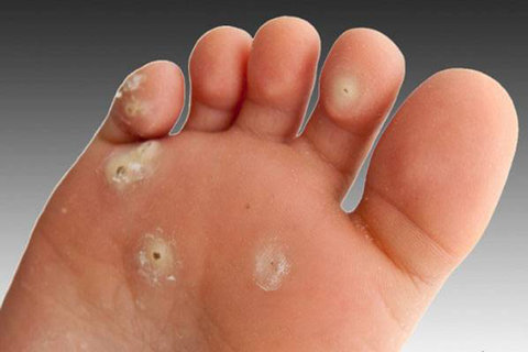 کفش تنگ؛ علت اصلی میخچه پا/ کوتاهی ارتفاع کفش منجر به عارضه "انگشت چکشی" می‌شود