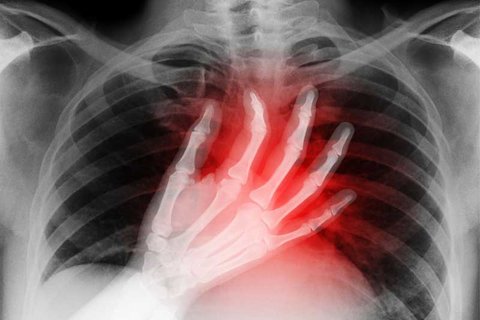 ۹۰ درصد دردهای قفسه سینه کودکان منشأ غیرقلبی دارند