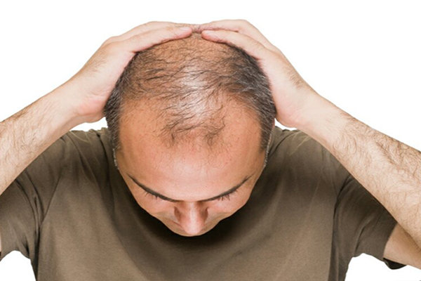 درمان ریزش ‌مو طولانی ‌مدت ‌است