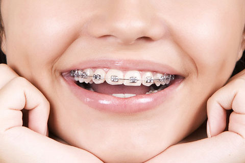امکان ارتودنسی دندان‌ها در میانسالی و بزرگسالی