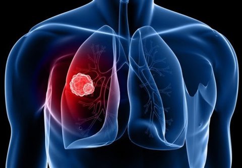 علائم رایج سرطان ریه چیست؟