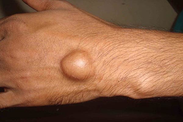 "گانگلیون"؛ شایع ترین توده مچ دست/ بیماری بیشتر در میان زنان ۲۰ تا ۳۰ سال دیده می‌شود