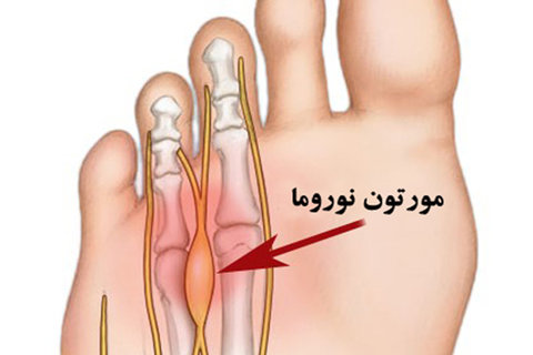 عارضه "مورتون نوروما"؛ به دلیل  کفش تنگ ایجاد می شود/ در زنان۱۰ برابر شایع تر از مردان