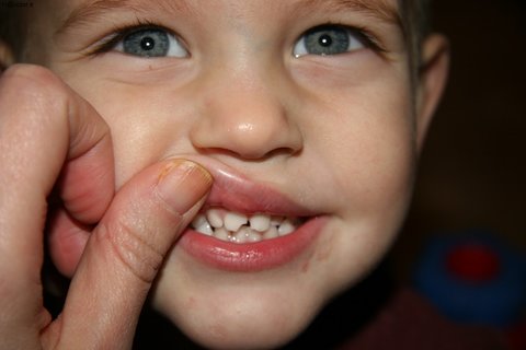 پوسیدگی دندان‌های شیری دامنگیر دندان‌های دایمی می‌شود 