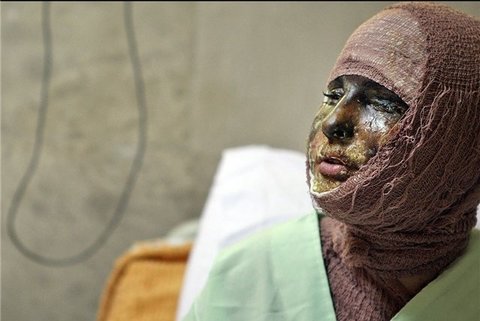 تصویب لایحه کمک به تامین هزینه درمان مصدوم اسیدپاشی در تبریز