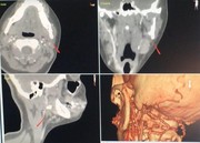 نخستین جراحی خارج کردن جسم خارجی از گردن در اصفهان انجام شد