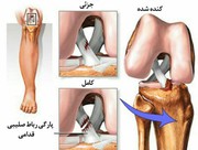 پارگی رباط صلیبی قدامی بلای جان هافبک ها