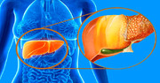 کبد چرب چگونه درمان می‌شود؟