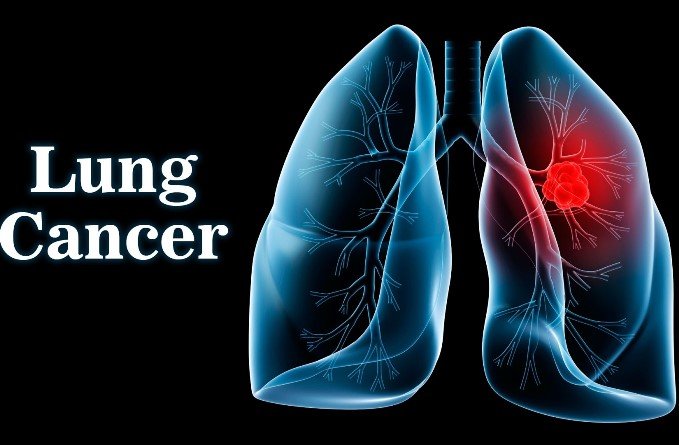 شناسایی منشاء سرطان ریه در افراد غیرسیگاری