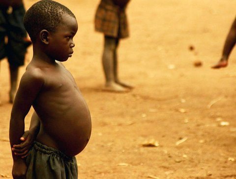 کواشیورکور؛ بیماری کودکان جهان سومی‌