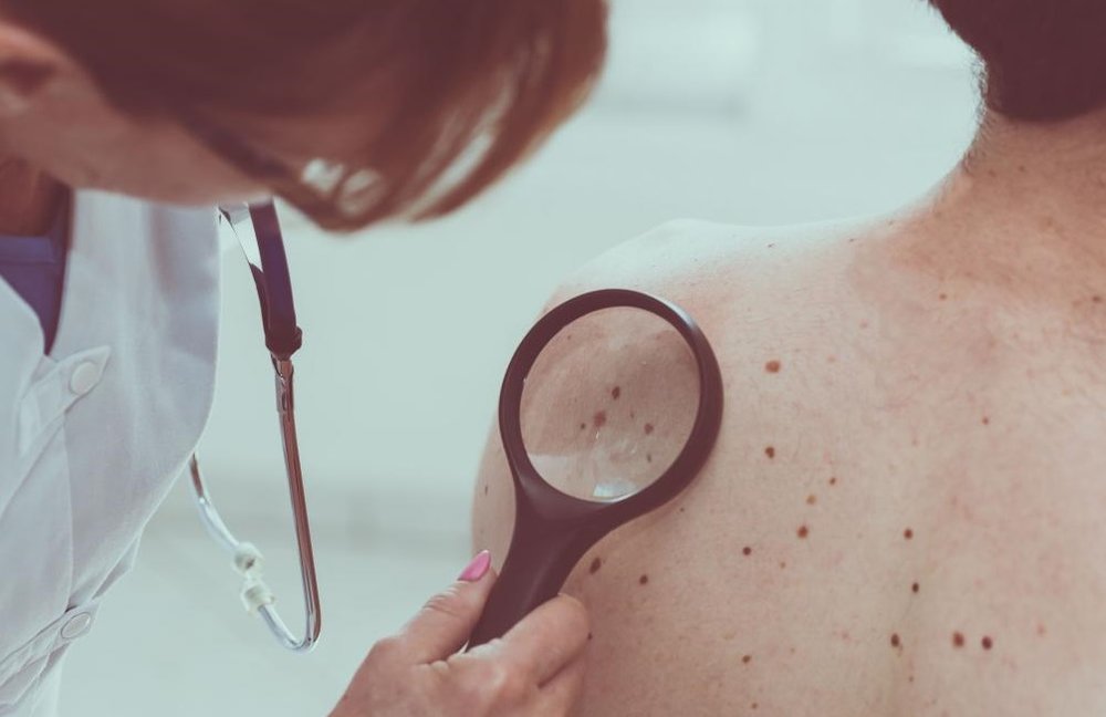 سرطان پوست؛ معیاری برای تشخیص سرطان‌های دیگر
