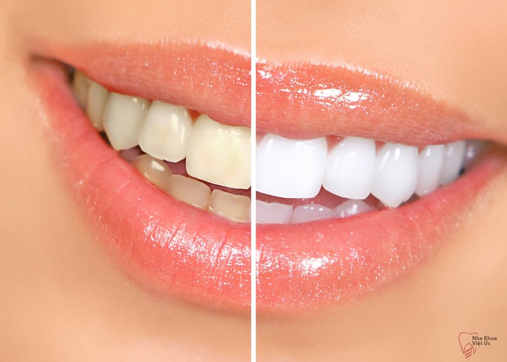 سفید کردن، دندان ها را نازک می کند