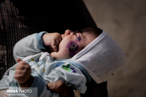 علی اصغر کودک 40 روزه ورزنه ایی که نیمی از صورتش درگیر سالک است