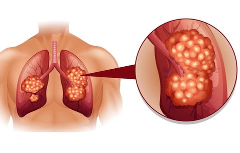 علائم خاص سرطان ریه چیست؟