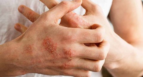 آیا ضایعات پوستی از علائم کرونا است؟