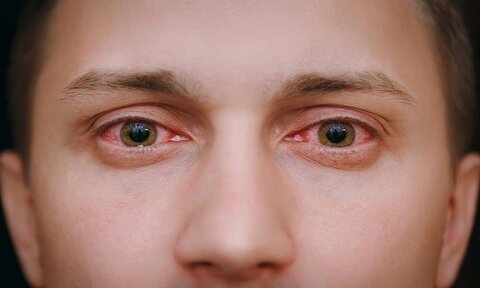 نشانه‌های عفونت چشمی خطرناک