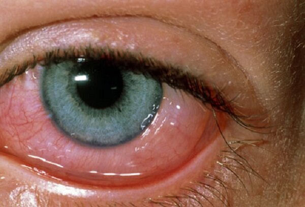 آلرژی چشم و روش‌های درمان آن