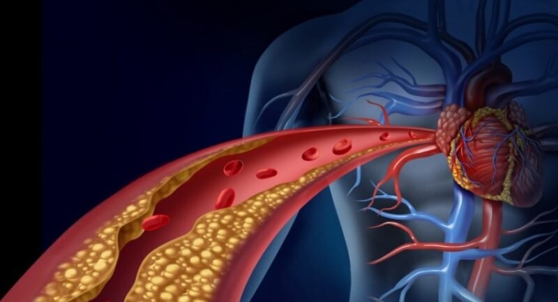 بیماری عروق کرونر قلب چه علائمی دارد؟