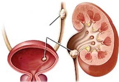 علت ابتلا به سنگ مثانه چیست؟ 