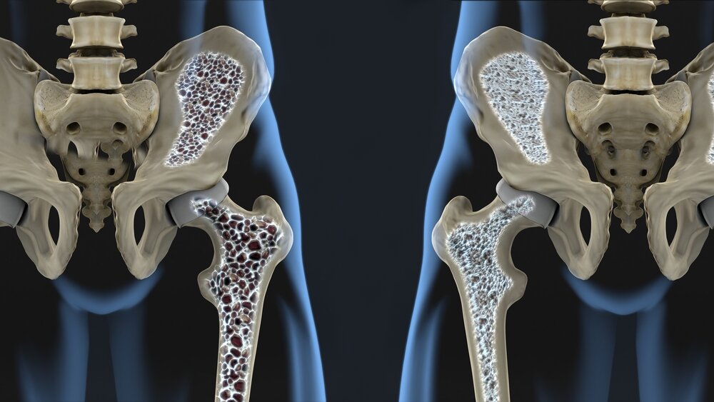 راهکارهای موثر برای درمان کاهش تراکم استخوان‌ها