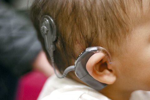 هیچ کودکی پشت نوبت دریافت کمک هزینه کاشت حلزون شنوایی نیست