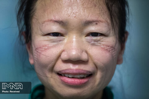 علائم باقی مانده پس از پوشیدن ماسک بر روی صورت پرستار که در بیمارستان شهر ووهان چین کار می کرد