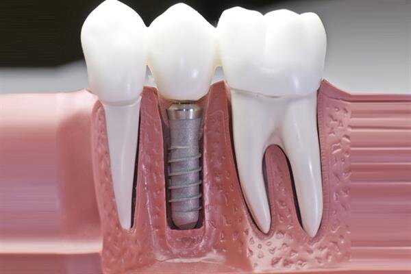  ایمپلنت؛ روشی نوین برای جایگزینی دندان