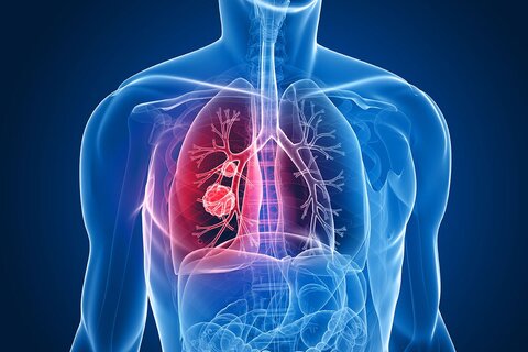 تأیید ارتباط نارساییِ تنفسی ناشی از کرونا با گروه خونی