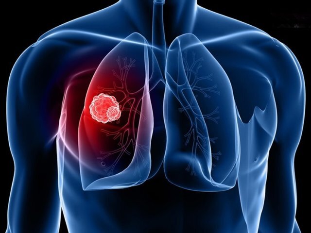 آمبولی ریه چیست و چه علائمی دارد؟