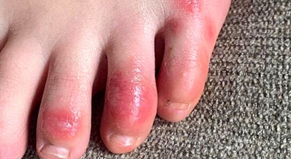 انگشت پای کوویدی؛ عارضه طولانی مدت بیماری کرونا