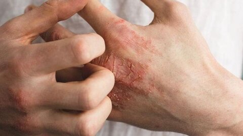 نشانه‌های پوستی بیماری کبدی کدام است؟  