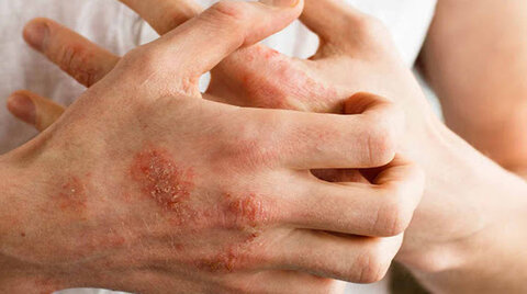 روش‌هایی برای درمان خارش پوست که به‌دلیل نیش حشرات به وجود آمده است