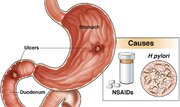 زخم معده چیست؟+ عوامل، علائم، عوارض و پیشگیری