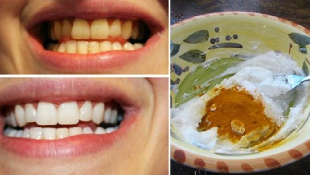 آیا سفید کردن دندان با زردچوبه امکان پذیر است؟