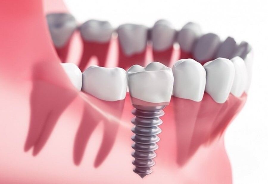 هزینه ایمپلنت دندان، آنچه باید بدانید