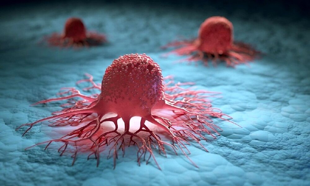 تشخیص زودهنگام سرطان با تولیدات داخل