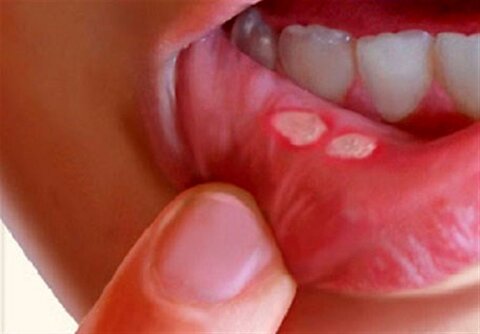 آفت دهان چیست؟+ علائم و درمان