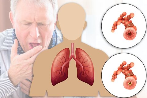 بیماری کووید-۱۹ باعث آسیب طولانی‌مدت به ریه‌ها می‌شود