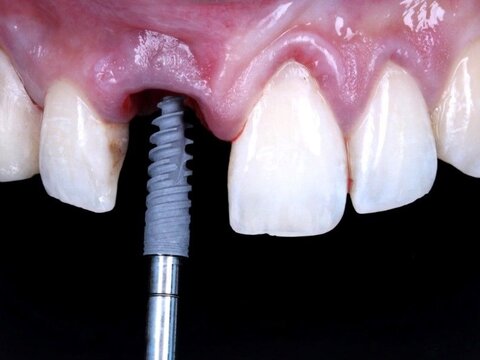 ابداع یک ماده ابریشمی برای پر کردن دندان