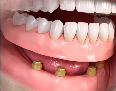 مقایسه روش های کاشت دندان، کدام بهتر است؟
