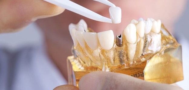 مقایسه روش های کاشت دندان، کدام بهتر است؟