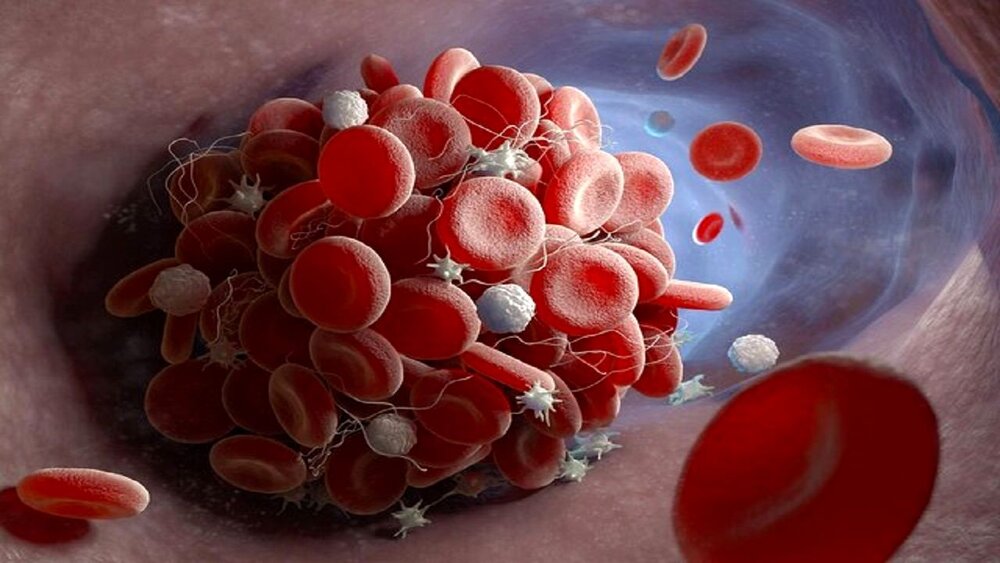 احتمال لخته شدن خون بیماران مبتلا به سرطان