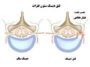 درمان دیسک کمر و گردن با طب فیزیکی و بدون نیاز به جراحی